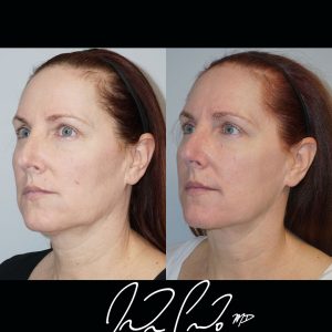 Neck Liposuction with Accutite