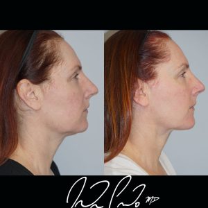 Neck Liposuction with Accutite