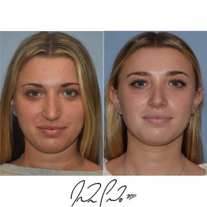 Rhinoplasty