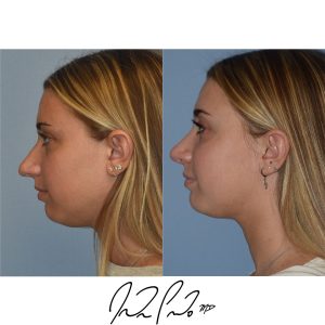 Rhinoplasty