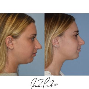Rhinoplasty