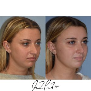 Rhinoplasty