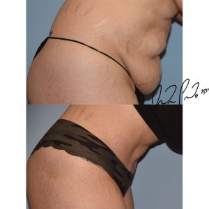 Abdominoplasty