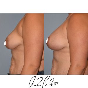 Breast Lift with Augmentation
