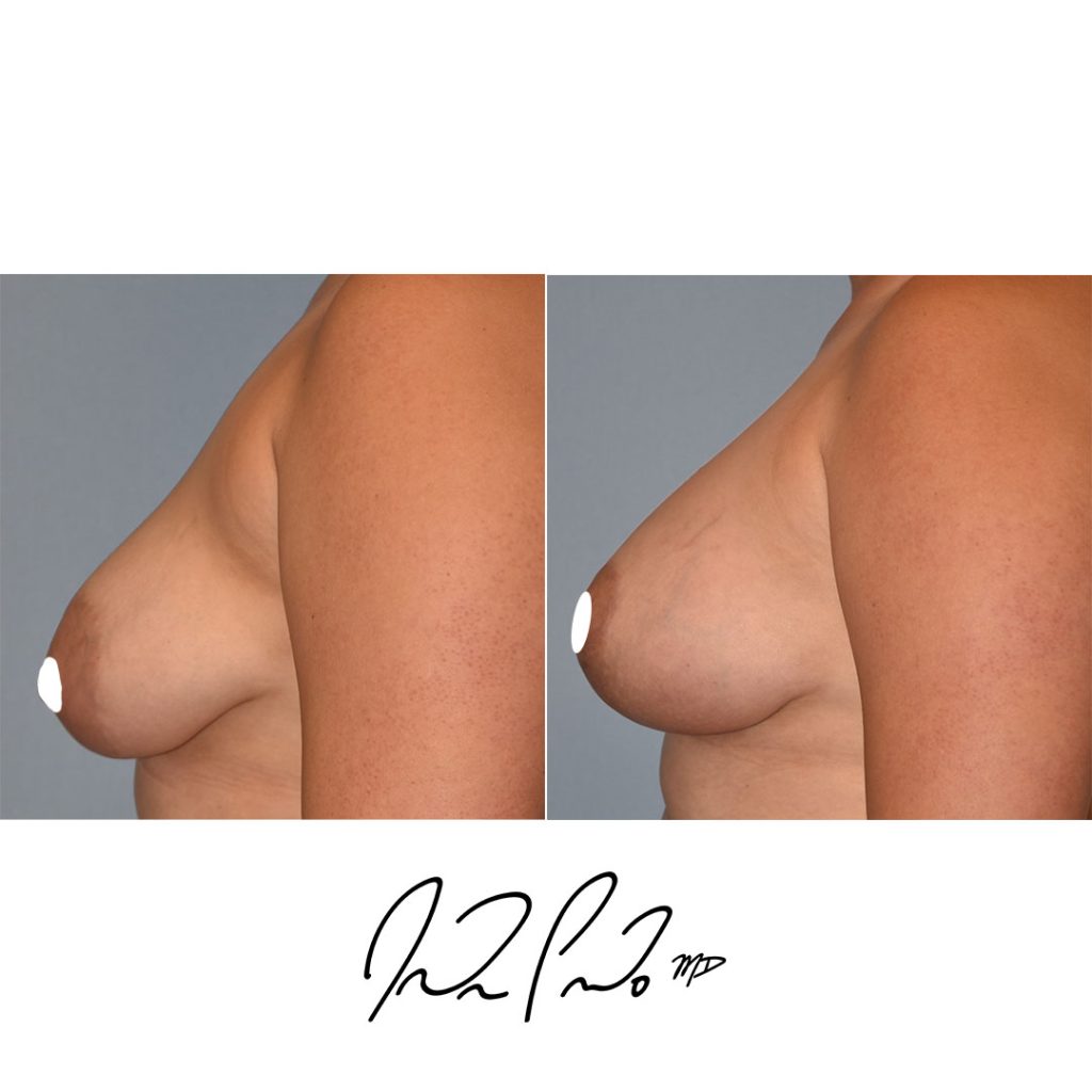 Breast Lift with Augmentation Case 2