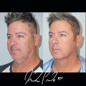 Minimally Invasive Neck Lift