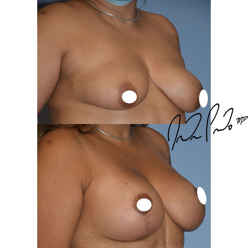 Breast Lift with Augmentation Case 3