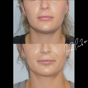 Neck Liposuction